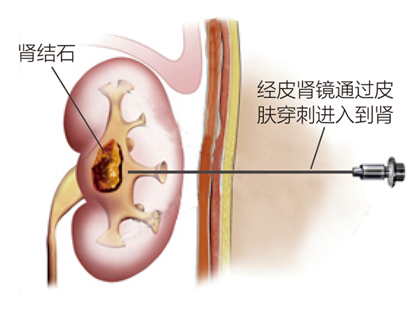 超微经皮肾镜取石术