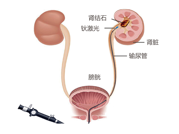 无创输尿管软镜取石术